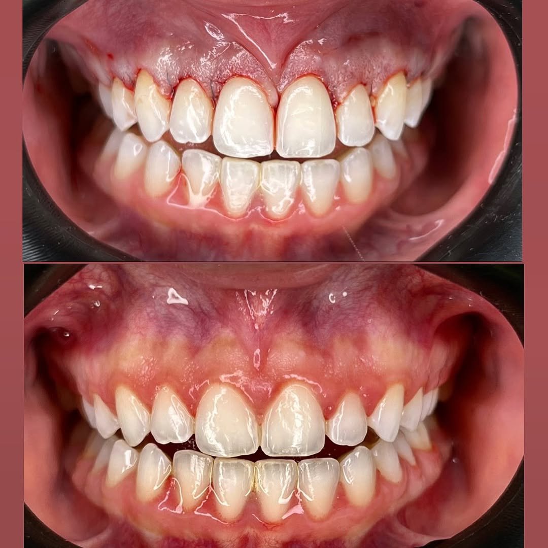 Reabilitação completa