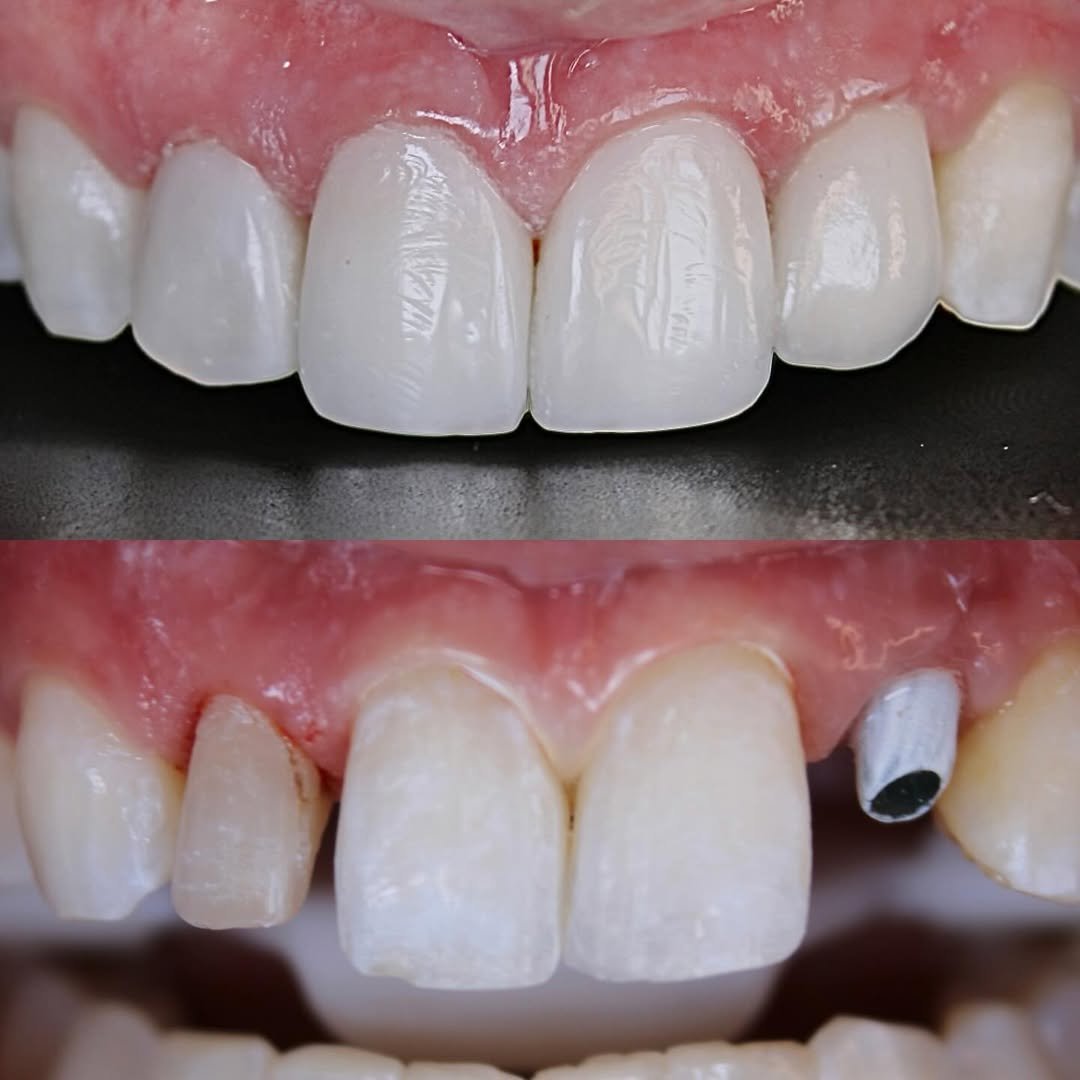 Implante unitário anterior